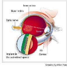 Bientôt des yeux bioniques Bientôt des yeux bioniques